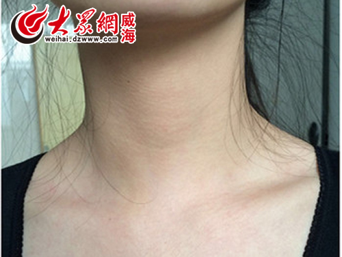 甲状腺结节偏爱女性 微创手术颈部美无痕